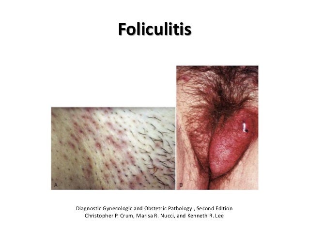 que es la foliculitis vaginal Big bust cum shots